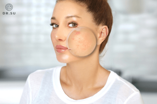 Dermatologists on Adult Acne - Dr. Su Glow x Grow