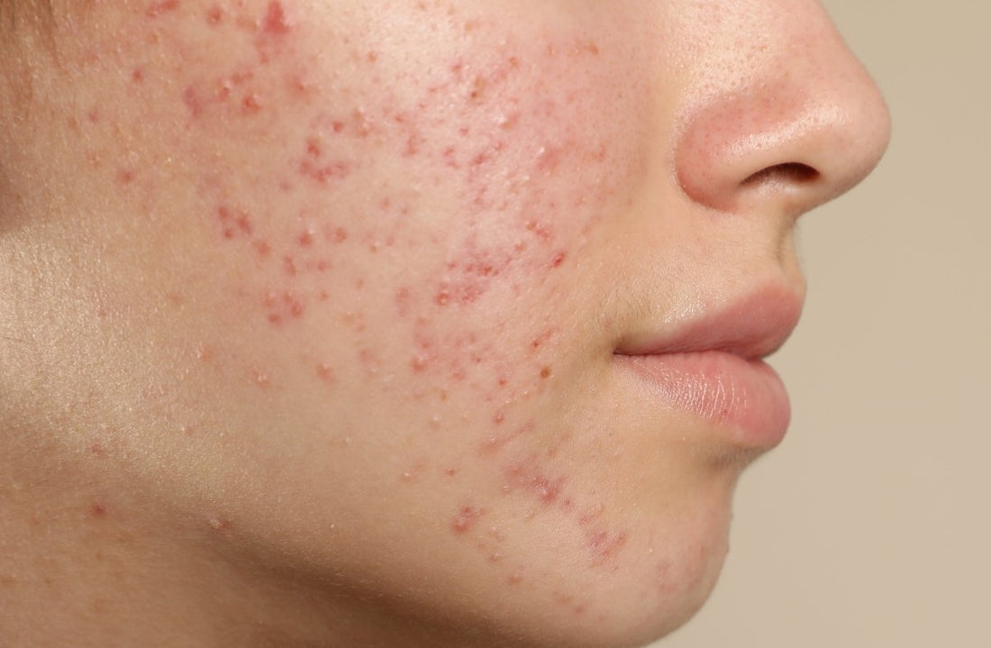 5 Morning Habits That Are Making Your Acne Worse β Dr. Su