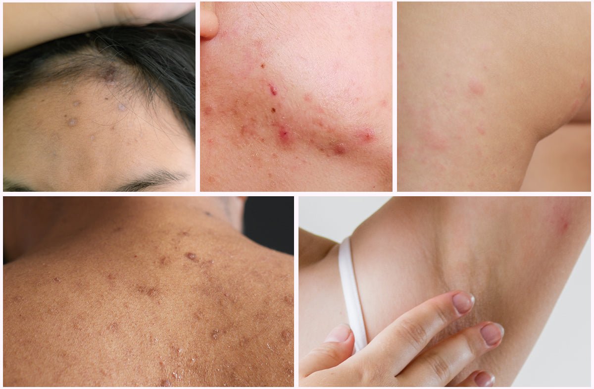 5 Weird Places Acne Shows Up (And What to Do About It)