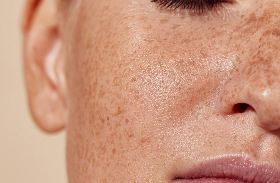 7 Reasons Your Hyperpigmentation Isn't Fading Despite Sunscreen - Dr. Su