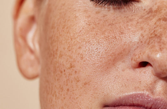 7 Reasons Your Hyperpigmentation Isn't Fading Despite Sunscreen - Dr. Su