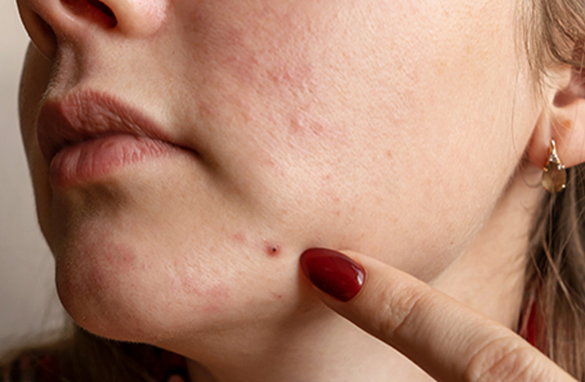 Acne Hacks: 5 Quick Ways To Calm A Pimple Fast