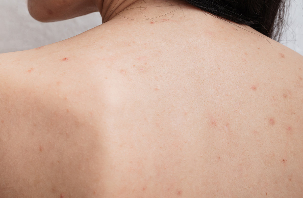 Back Acne & Body Acne: Causes, Treatments & Prevention Tips