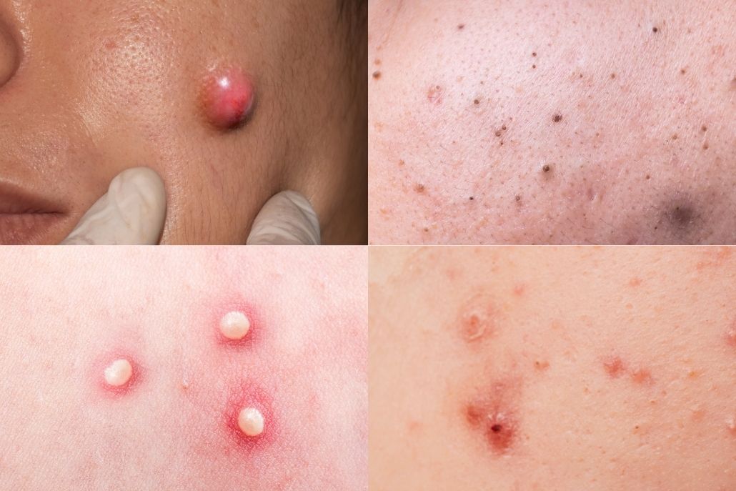 Acne 101: Types, Causes & Treatments Explained by Dermatologist - Dr. Su