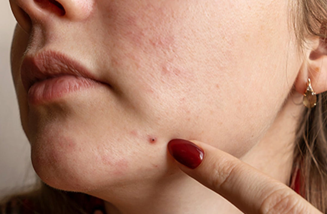 Acne Hacks: 5 Quick Ways To Calm A Pimple Fast - Dr. Su
