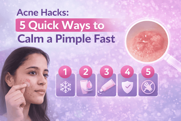 Acne Hacks: 5 Quick Ways To Calm A Pimple Fast