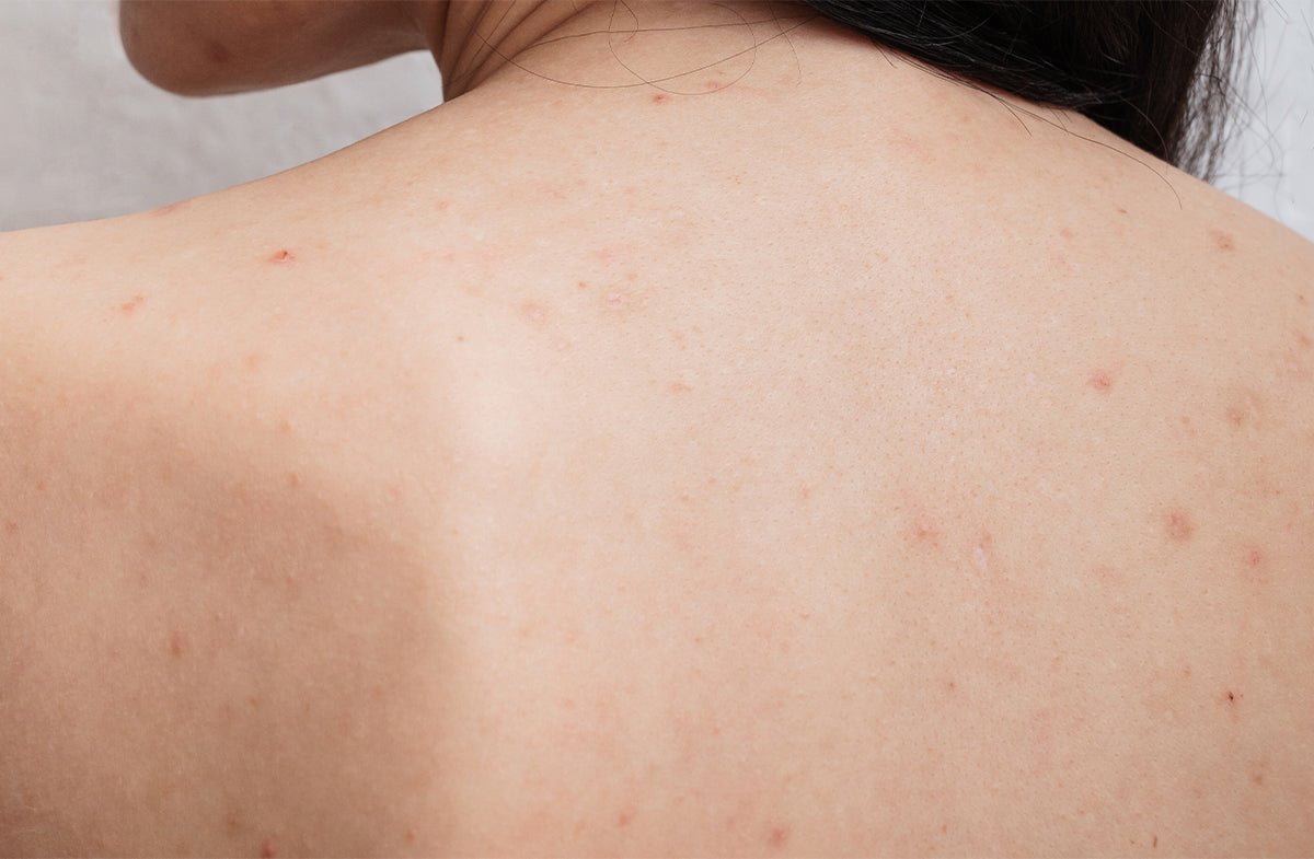 Back Acne & Body Acne: Causes, Treatments & Prevention Tips