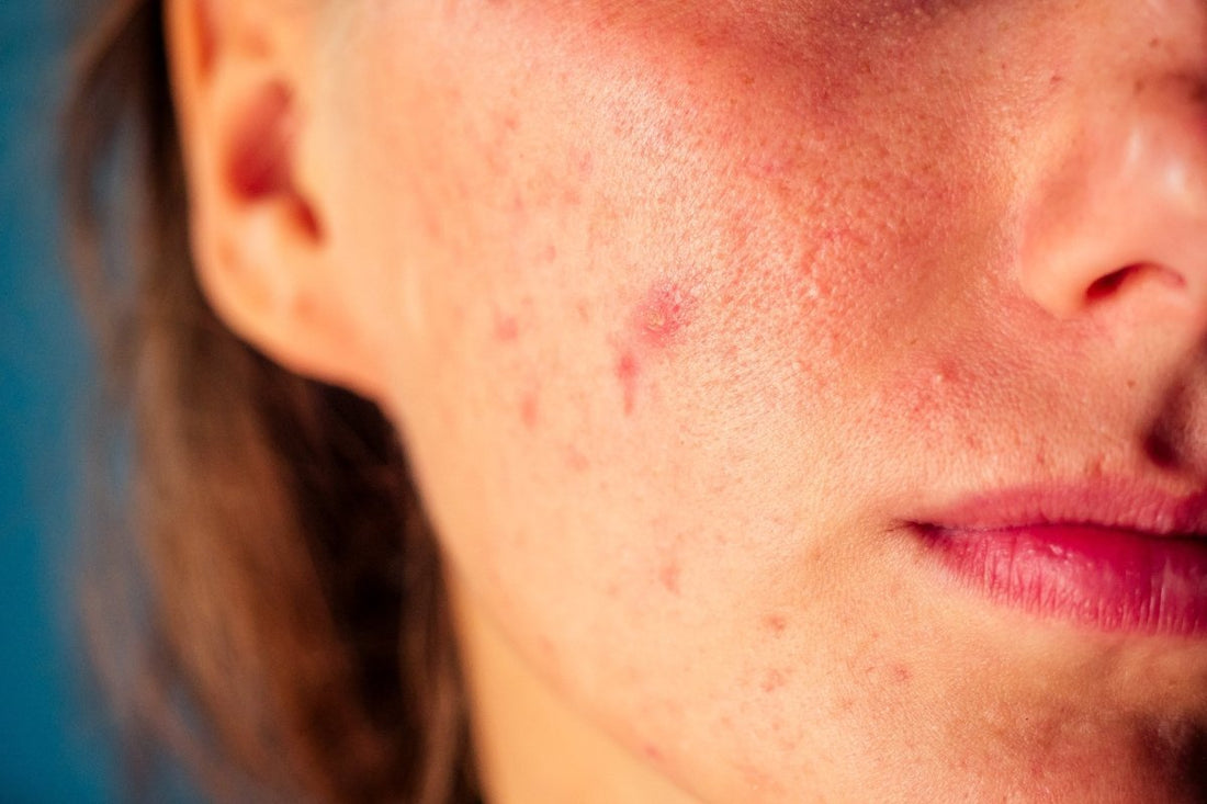 Barrier Repair For Hyperpigmentation: Why It Matters More Than You Think - Dr. Su