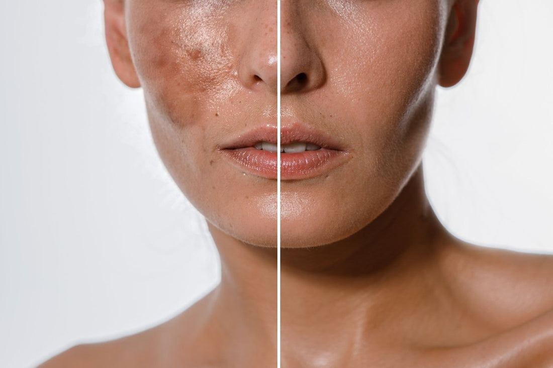 Can glycolic acid fade hyperpigmentation? Here's what science says! - Dr. Su