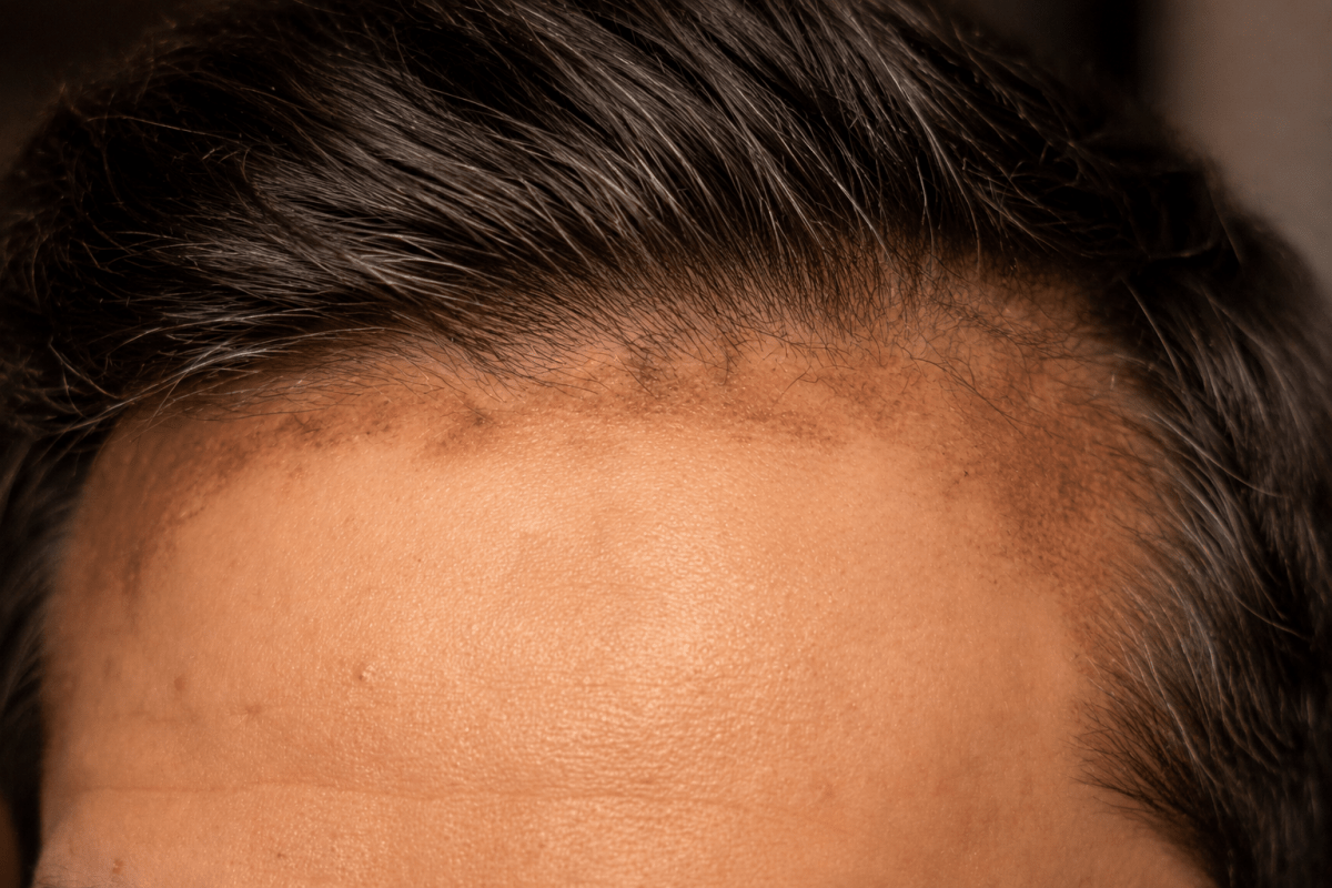 Can Scalp Inflammation or Hair Products Cause Face Hyperpigmentation?