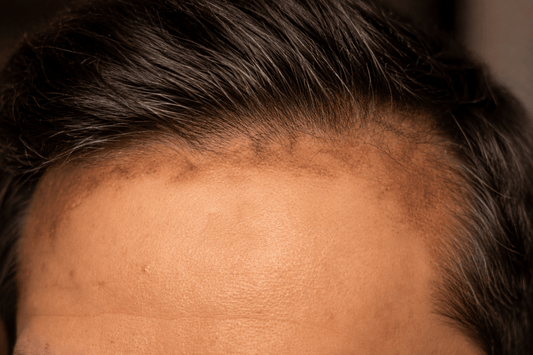 Can Scalp Inflammation or Hair Products Cause Face Hyperpigmentation? - Dr. Su