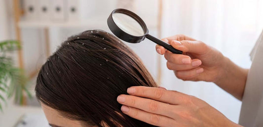 Dandruff 101: Causes and Prevention! - Dr. Su Formulations