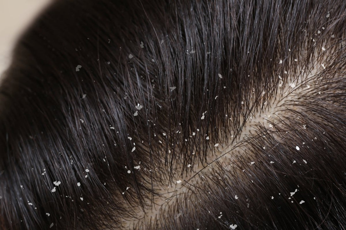 Dandruff 101: Causes and Prevention! - Dr. Su