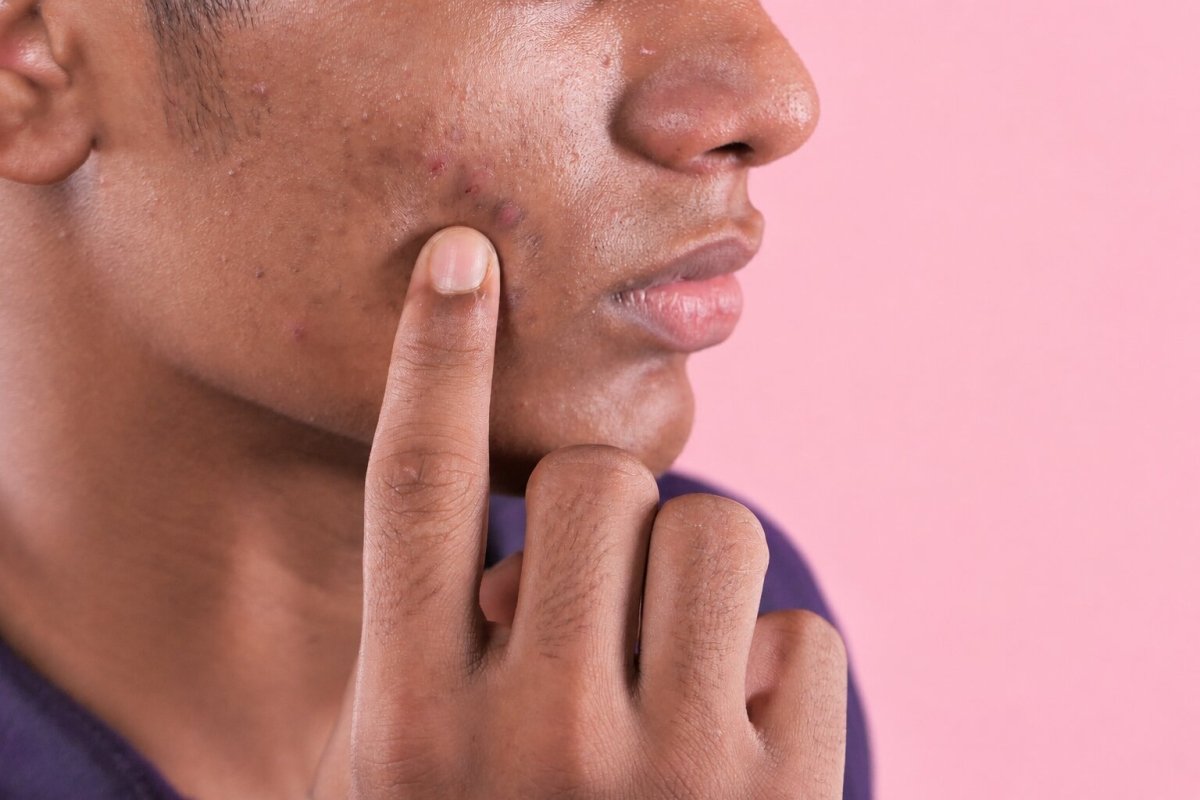How To Prevent Acne Scars And Hyperpigmentation After Breakouts