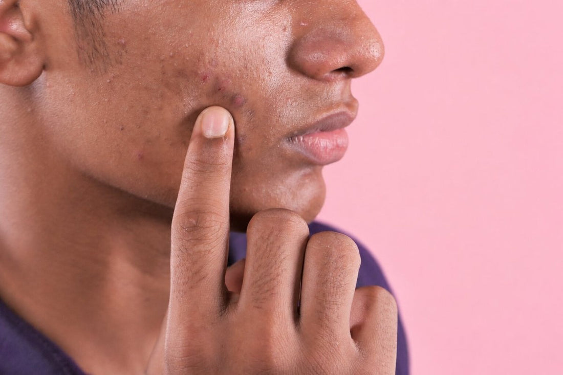 How To Prevent Acne Scars And Hyperpigmentation After Breakouts - Dr. Su