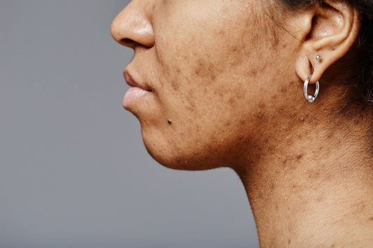 Hyperpigmentation After Acne: How to Treat Marks Without Irritation - Dr. Su