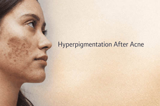 Hyperpigmentation After Acne: How to Treat Marks Without Irritation - Dr. Su