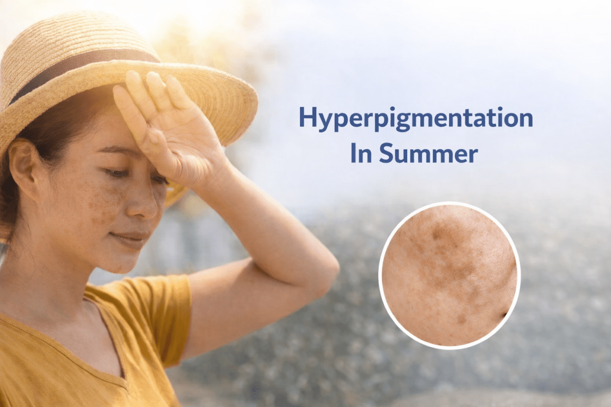 Hyperpigmentation In Summer: Daily Habits That Actually Prevent Dark Spots