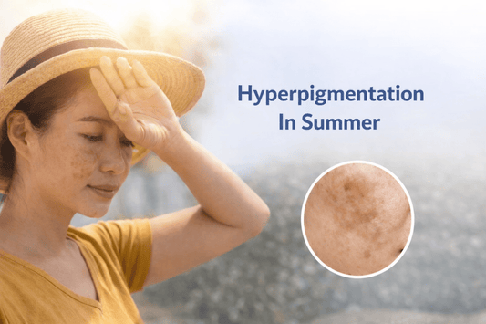 Hyperpigmentation In Summer: Daily Habits That Actually Prevent Dark Spots - Dr. Su