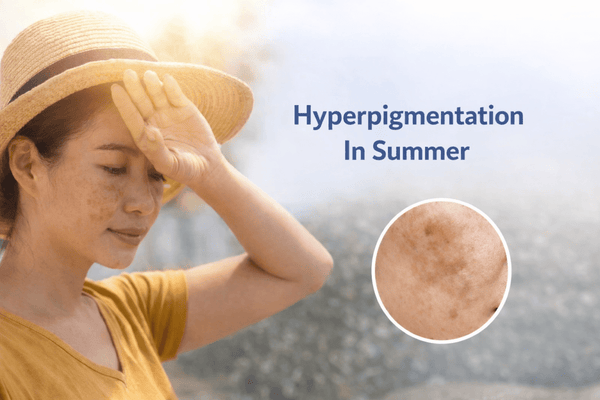 Hyperpigmentation In Summer: Daily Habits That Actually Prevent Dark Spots