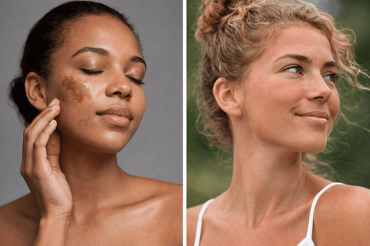 Hyperpigmentation Vs Sun Tan: How To Tell The Difference & Treat Each - Dr. Su