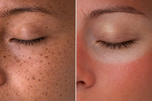Hyperpigmentation Vs Sun Tan: How To Tell The Difference & Treat Each - Dr. Su