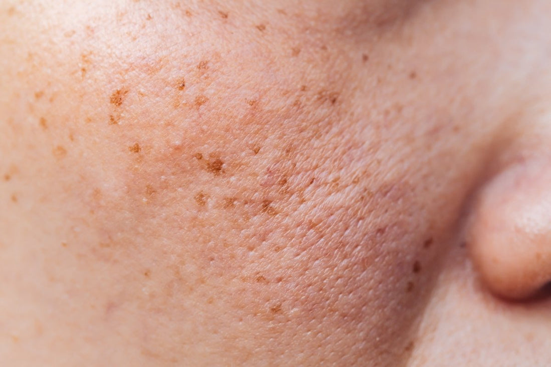 Kojic Acid for Dark Spots: How It Works and Why It’s So Effective - Dr. Su