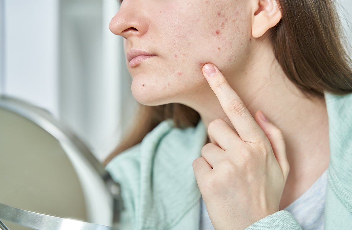 Mild Acne Got You Down? Here’s How to Treat It Effectively