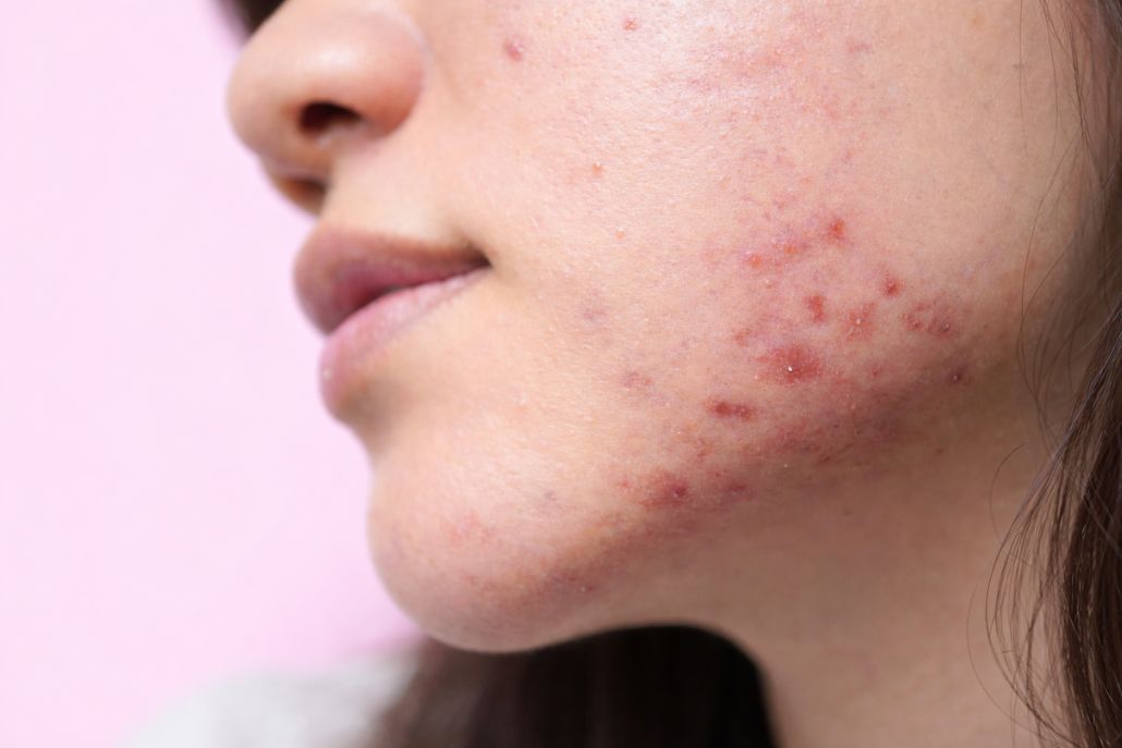 Period Acne: Causes, Management and Prevention!