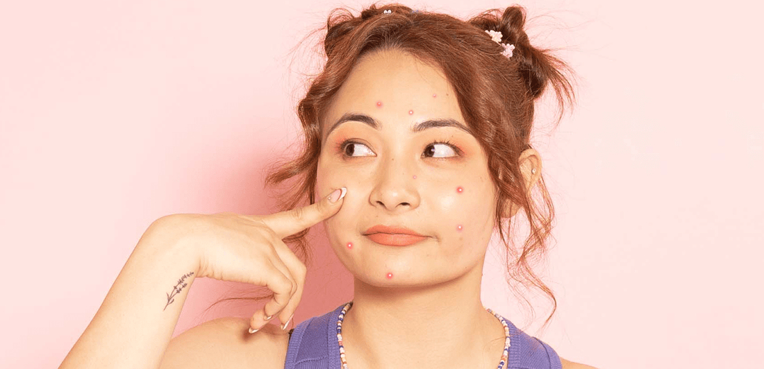 Period Acne: Causes, Management and Prevention! - Dr. Su Formulations