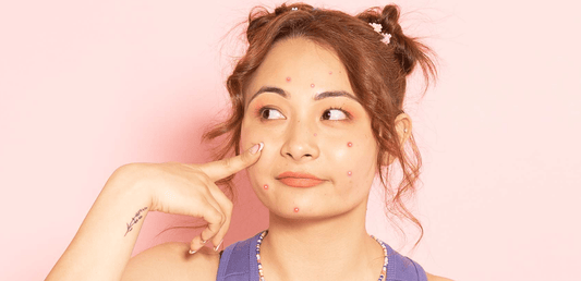 Period Acne: Causes, Management and Prevention! - Dr. Su Formulations