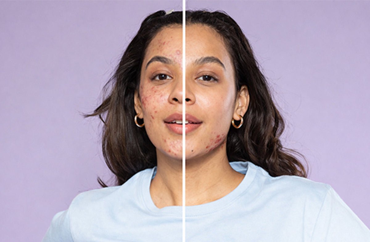 Period Acne vs. Everyday Breakouts: How Hormones Impact Your Skin