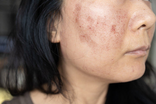 Post-Inflammatory Hyperpigmentation (PIH) In Teens And Young Adults: Causes & Care - Dr. Su