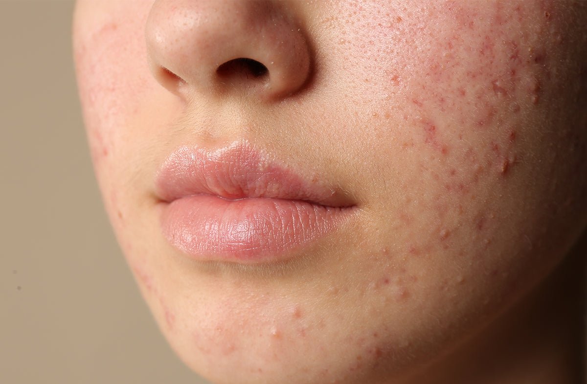 Rosacea or Acne? Key Differences and How to Tell Them Apart