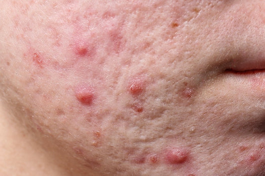 Salicylic Acid vs. Benzoyl Peroxide vs. Niacinamide: Best Ingredient for Acne-Prone Skin? - Dr. Su