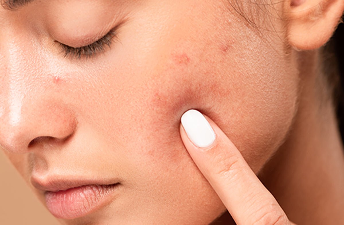 Sebaceous Hyperplasia vs. Acne: What’s Causing Those Bumps?