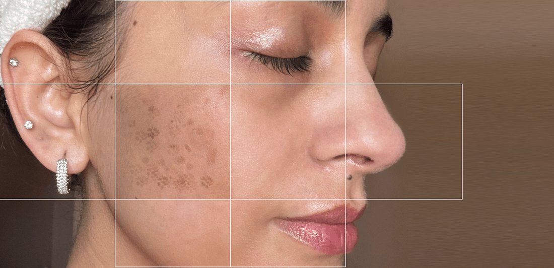 Skin Pigmentation: Causes & Solutions! - Dr. Su Formulations