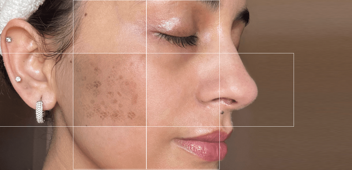 Skin Pigmentation: Causes & Solutions!