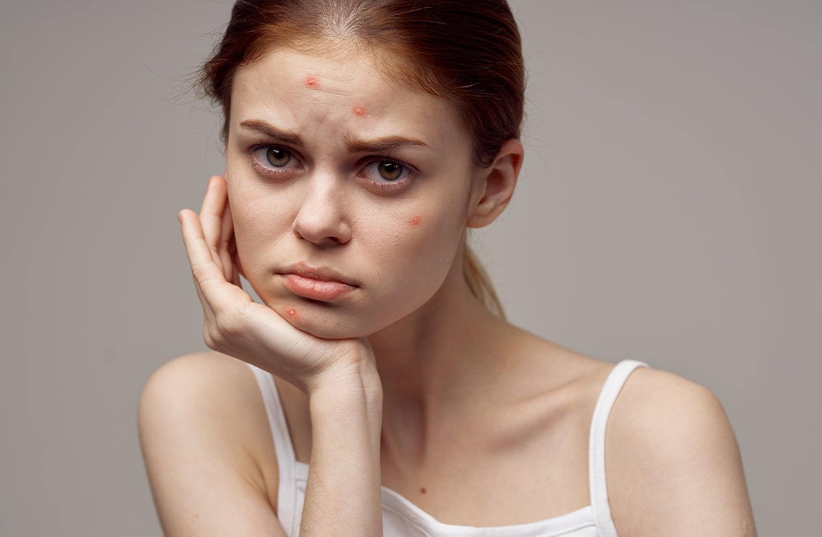 Teenage Acne: Causes, Treatments & Skincare Tips for Clearer Skin