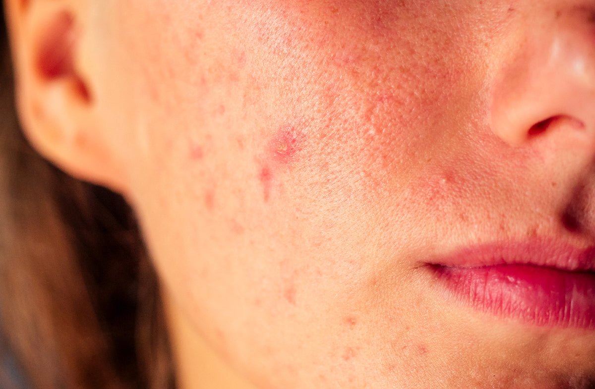 Top 3 Reasons Your Skin Keeps Breaking Out (Beyond Skincare)