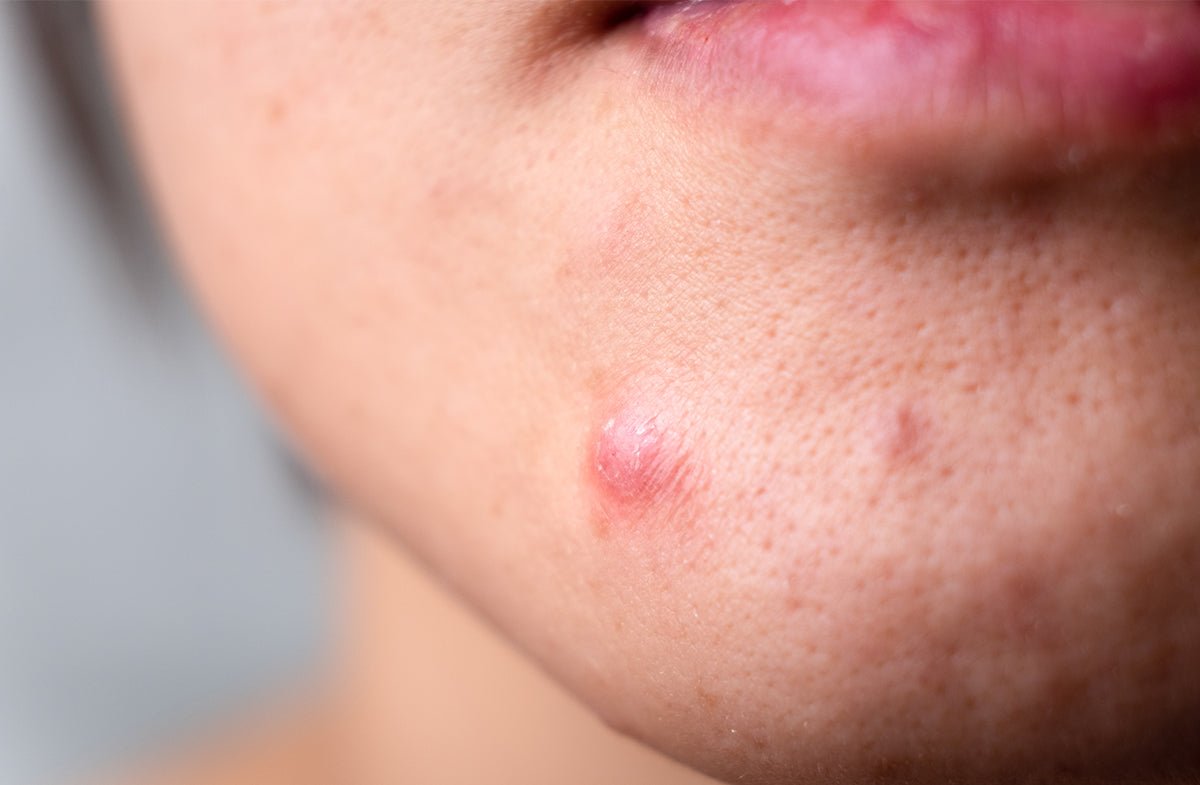 Why Adult Acne Happens (And How to Finally Get Rid of It)