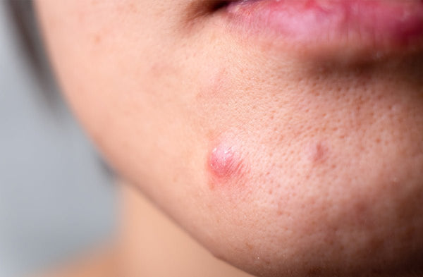Why Adult Acne Happens (And How to Finally Get Rid of It)