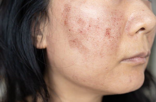 Why Melasma Gets Worse with Heat and What You Can Do About It