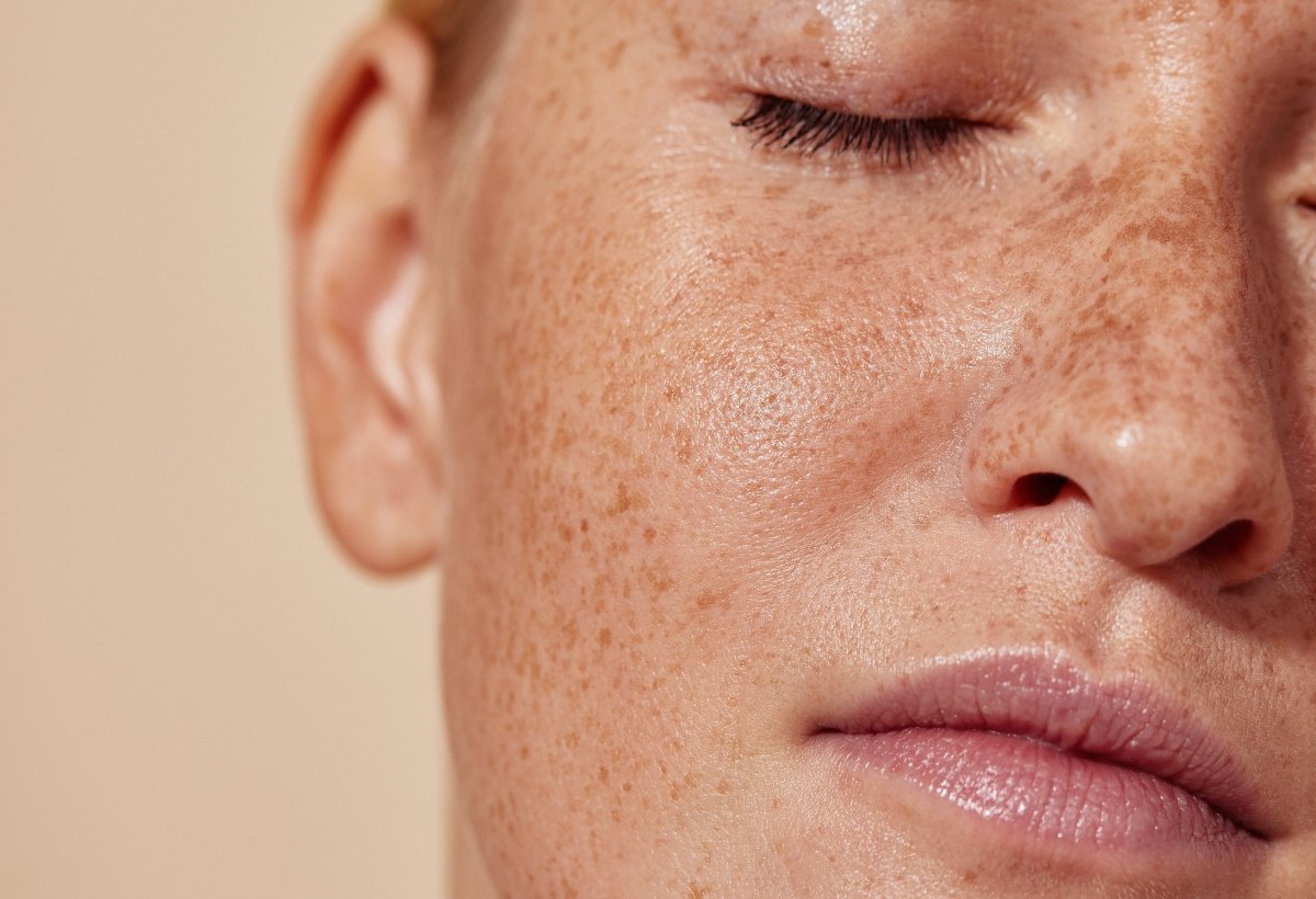 Why Pigmentation Comes Back After You Stop Treatments And What To Do