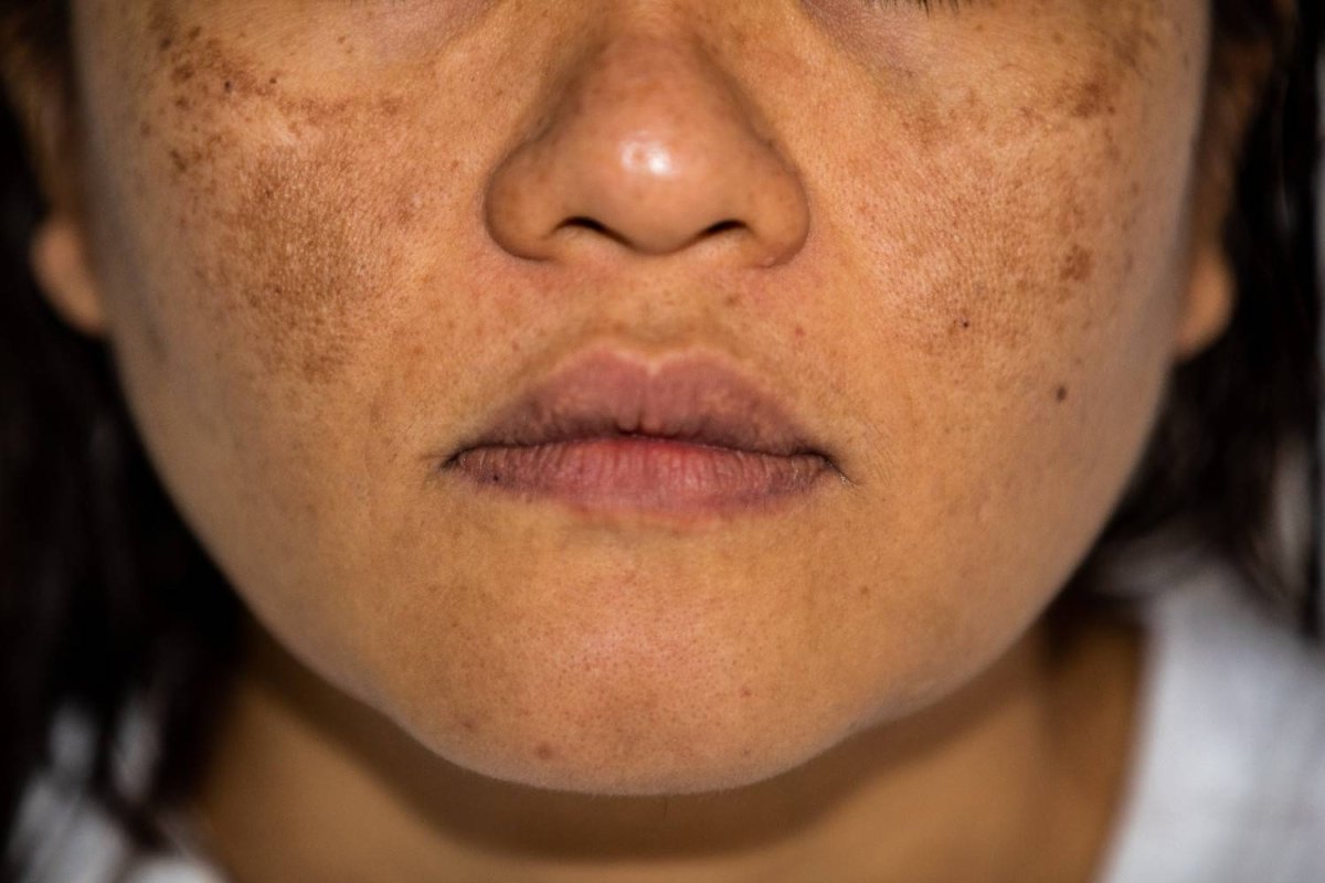 Why Your Hyperpigmentation Isn’t Fading (And What to Do Instead)