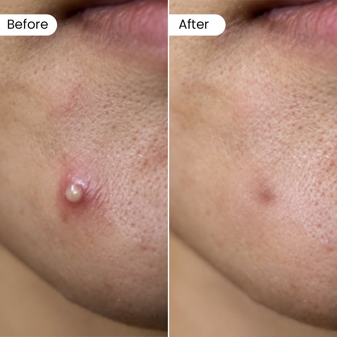 Dr. Su Acne Patches - Dr. Su