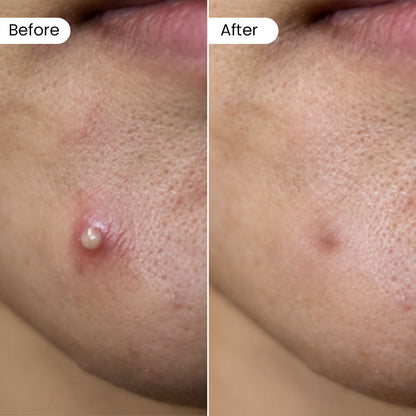 Dr. Su Acne Patches - Dr. Su
